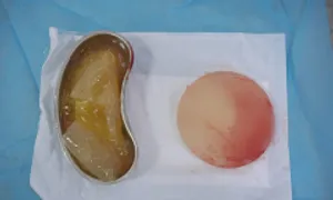 Thai phụ bị vỡ túi ngực sau 7 năm 'dao kéo' Thai phụ bị vỡ túi ngực sau 7 năm 'dao kéo'