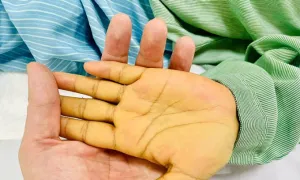 Nguy kịch vì hàng tỷ bản sao virus viêm gan B trong máu Nguy kịch vì hàng tỷ bản sao virus viêm gan B trong máu