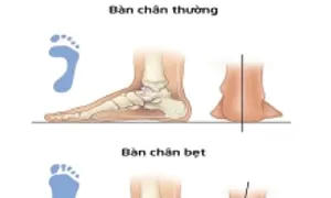 Cách nhận biết sớm bàn chân bẹt ở trẻ Cách nhận biết sớm bàn chân bẹt ở trẻ
